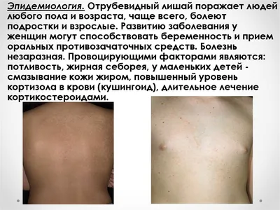 Разноцветный (отрубевидный) лишай. | DERMASILK | Дзен