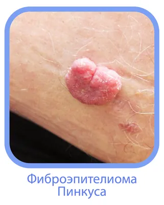 ᐈ Базалиома (базальноклеточный рак кожи) ~【Лечение в Киеве】