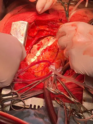 В Бишкеке провели сложную операцию при разрыве сердца после острого  инфаркта миокарда