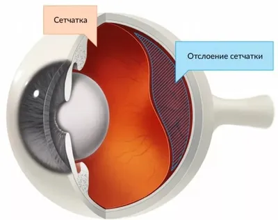 Отслоение, разрыв сетчатки глаза и армия | Помощь призывникам |  Призывник.Info | Дзен