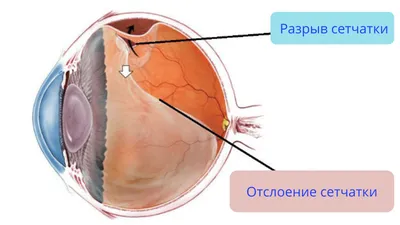 Отслоение сетчатки: симптомы, причины, диагностика, лечение