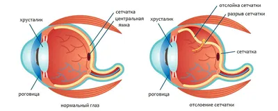 Рецидив отслойки сетчатки