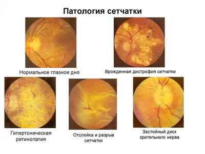 Лечение патологии сетчатки. Компания АртОптика г. Челябинск