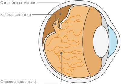 Отслойка сетчатки глаза: симптомы, диагностика, лечение, как проходит  операция и сколько она стоит