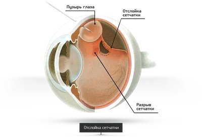 Отслойка сетчатки глаза симптомы и классификация, причины отслойки сетчатки  глаза