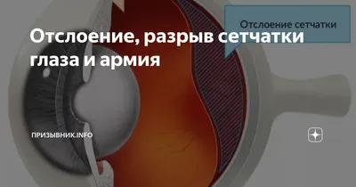 Отслоение, разрыв сетчатки глаза и армия | Помощь призывникам |  Призывник.Info | Дзен