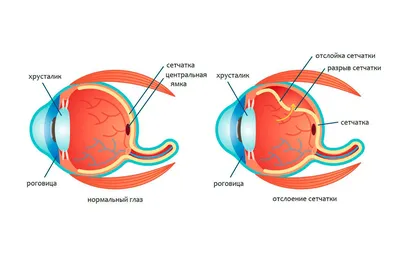 Разрыв сетчатки глаза: близорукие – в зоне риска | Медпортал SIBMEDA | Дзен