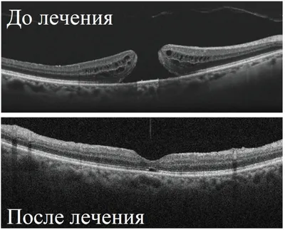 Отслоение сетчатки - глазная клиника Чакмак-Көз витреоретинальный центр г.  Бишкек.