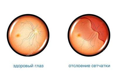 Отслоение сетчатки операция лечение в Визус-1