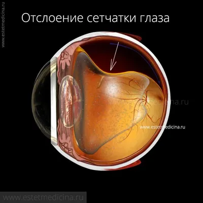 Виды отслойки сетчатки глаза, причины и методы лечения | Центр  микрохирургии глаза Макарчука - офтальмологический центр в Бресте