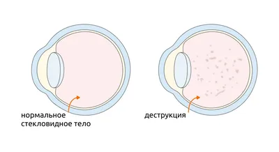 Лазерная коагуляция сетчатки глаза: цены на операцию ППЛК, консультация  офтальмолога в клинике «Эксимер»