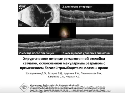 Отслойка сетчатки: симптомы, диагностика и лечение