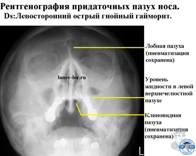 Рентгенография придаточных пазух носа - фото - ЛОР в Самаре - врач Лунёв  Андрей Владимирович