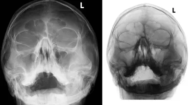 Рентген придаточных пазух носа в Москве от 1150 руб