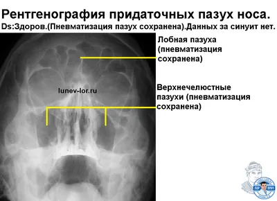 Рентгенография придаточных пазух носа - фото - ЛОР в Самаре - врач Лунёв  Андрей Владимирович