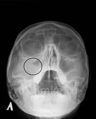 Гайморит на рентгене. Диагностика, лечение, рекомендации. Врач на дому -  Рентген на дому в С-Петербурге в день вызова
