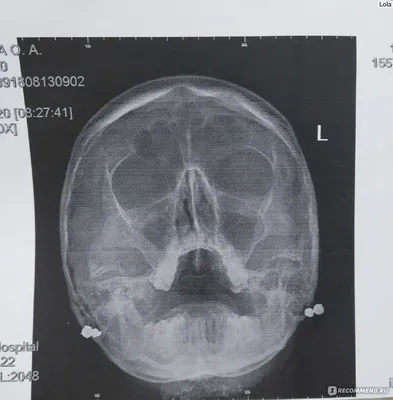 Рентгенография придаточных пазух носа - «Гайморит хронический. Как помогает  рентген поставить правильный диагноз. Симптомы гайморита без рентгена, как  понять, что нужно бежать к лору. » | отзывы