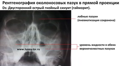 Рентгенография придаточных пазух носа - «Поставили кисту по рентгену пазух  носа. В итоге диагноз оказался неверным. Очень приблизительное  исследование, с которым нужно быть осторожнее.» | отзывы