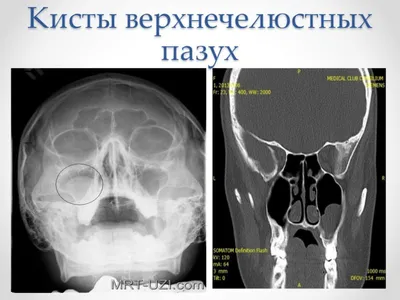 Лечение гайморита (синусита) в Санкт-Петербурге - цена в клинике Балтмед