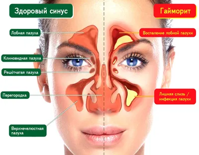 Киста гайморовой пазухи. Симптомы и лечение