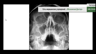 Инородное тело в гайморовой пазухе - Центр приватной стоматологии «Доктор  Левин»