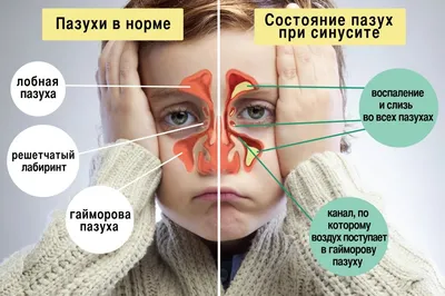 Повреждение гайморовых пазух при имплантации зубов [Что делать?]