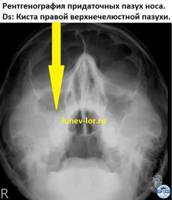 Рентгенография придаточных пазух носа - фото - ЛОР в Самаре - врач Лунёв  Андрей Владимирович