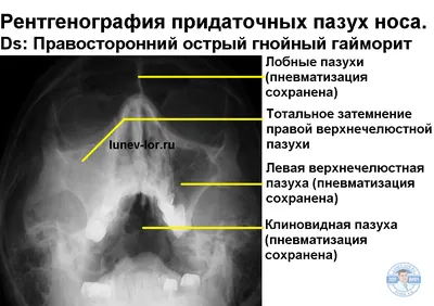 Цифровая рентгенография придаточных пазух носа