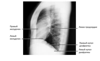 Рентгенологические границы сердца | КлинКейсКвест
