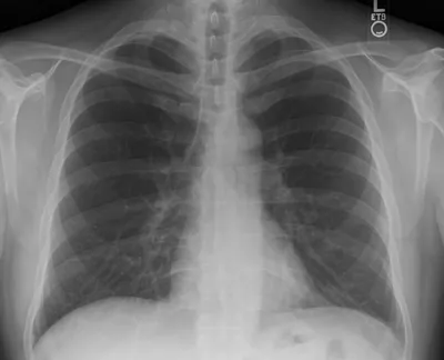 Рентгенологическая анатомия сердца | Анатомия сердца на рентгене - YouTube