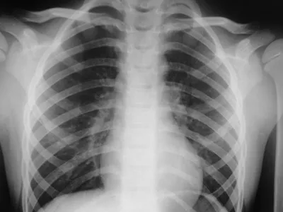 Рентген Сердца | Портал радиологов