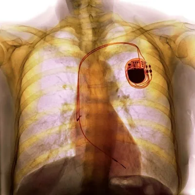 рентген грудной клетки пациента с остановкой сердца Стоковое Фото -  изображение насчитывающей болезнь, ключица: 110673302