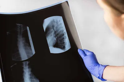 Рентгенография органов грудной клетки - Системный подход