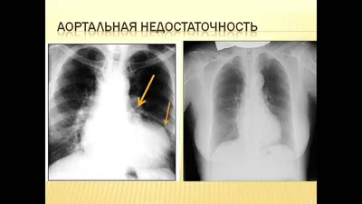 Рентгенснимок его сердца облетел весь мир: боец НГУ после тяжелого ранения  вернулся на передовую