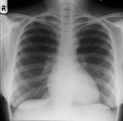 Рентгенологическая картина аортальной формы сердца - YouTube