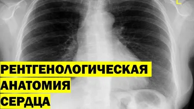 Рентген грудной клетки, сердце, легкие, косточки и грудная клетка Стоковое  Фото - изображение насчитывающей анархиста, легке: 88903932