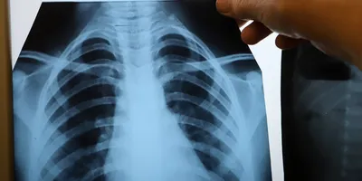 Рентгенография сердца | Портал радиологов