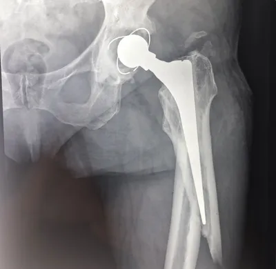 Рентген признаки артроза тазобедренного сустава
