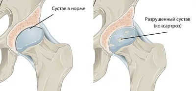 Травмы тазобедренных суставов - причины, симптомы, кто лечит