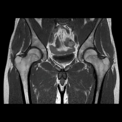 Hip dysplasia (Coxa Valga) | Bowlegs