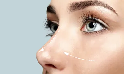Контурная пластика носа в Израиле - Доктор Эли Шульман - коррекция формы  носа
