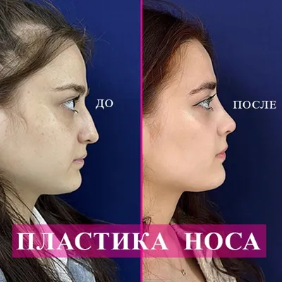 Неудачная ринопластика носа. Фото до и после.