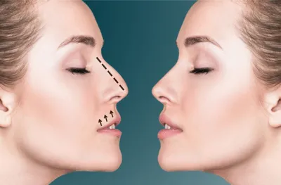 Уникальный метод бескровной хирургии представили ученые: форму носа можно  изменить без операции