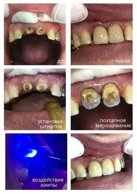 Реставрация зубов в Москве | стоматологическая клиника Нардент