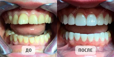 Художественная реставрация передних зубов — моделирование до и после |  Dental Art