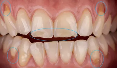 Фото зубов ДО и ПОСЛЕ, передние зубы, фото протезирования, коронки, виниры,  отбеливание