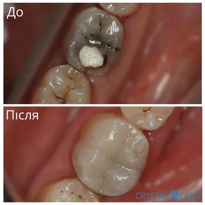 Реставрация зубов Харьков | Разумная Цена | Dental Line