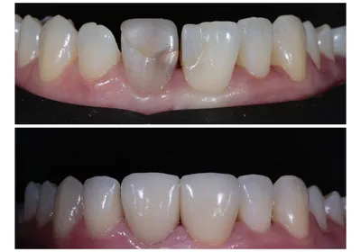 Травма зуба, перелом коронковой части переднего зуба. Реставрация  фотополимером