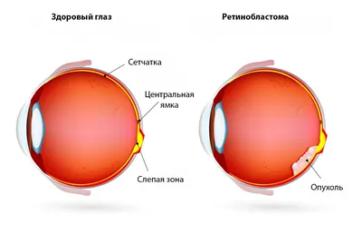 Рак глаза: симптомы, причины, лечение «Ochkov.net»