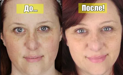 Желтый пилинг для лица в СПб: цена процедуры ретинолового желтого пилинга в  клинике косметологии Космед